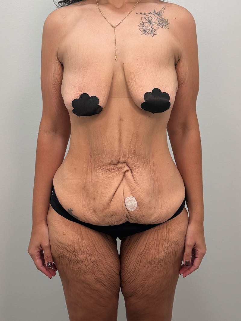 Brazilian Butt Lift Before & After Gallery - Patient 193824 - Image 3