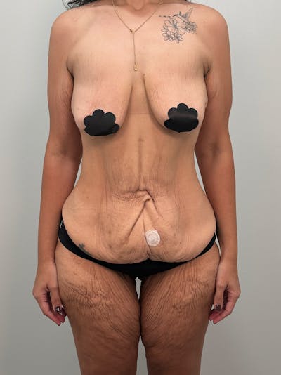 Mommy Makeover Before & After Gallery - Patient 336459 - Image 1