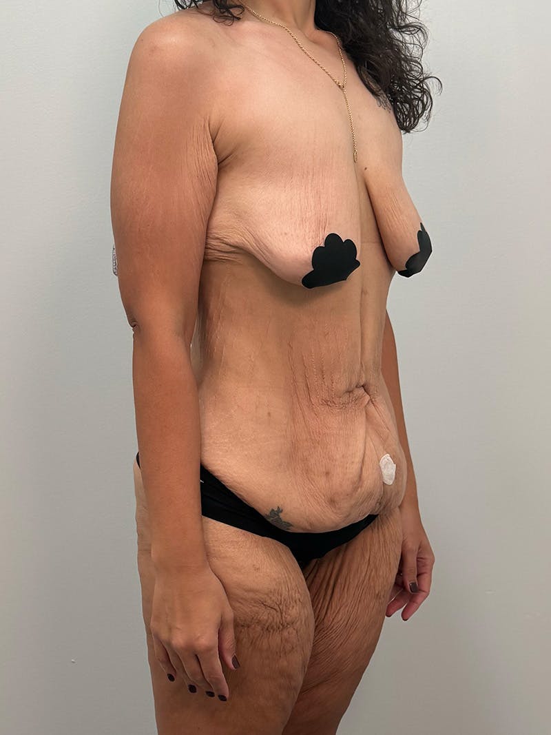 Brazilian Butt Lift Before & After Gallery - Patient 193824 - Image 5