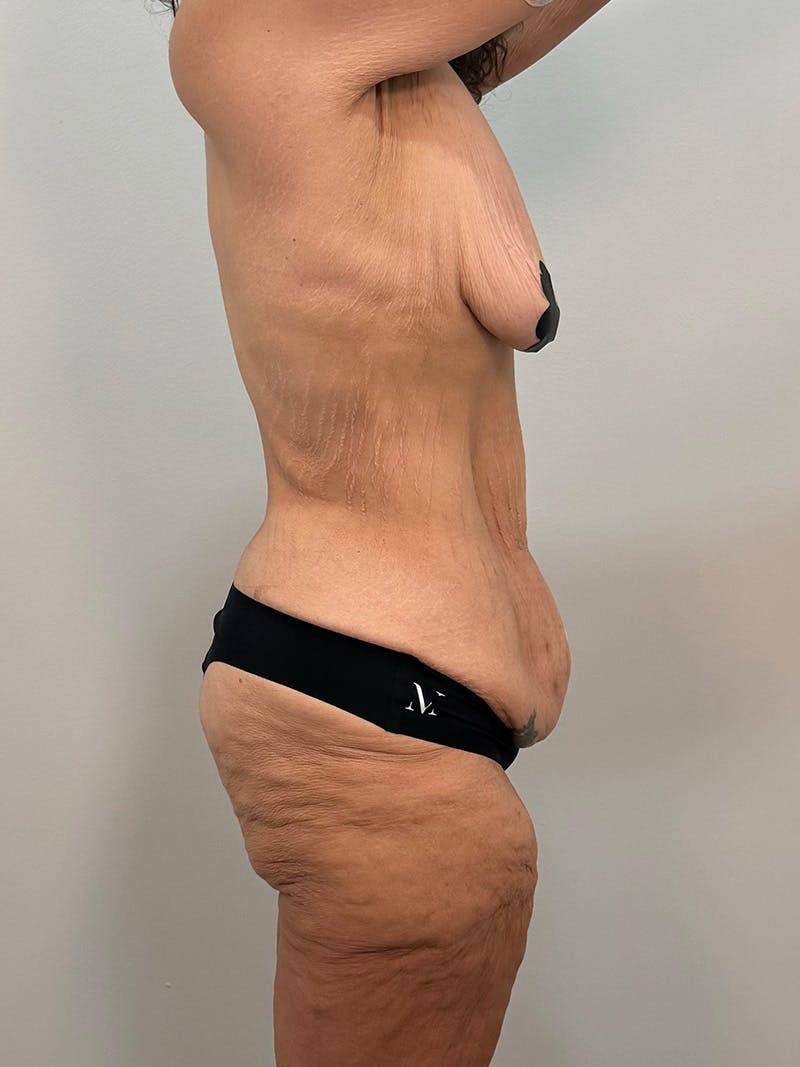 Brazilian Butt Lift Before & After Gallery - Patient 193824 - Image 7
