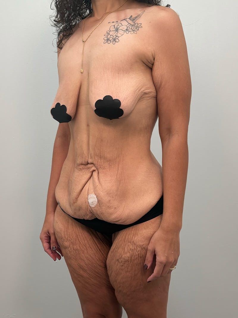 Brazilian Butt Lift Before & After Gallery - Patient 193824 - Image 9