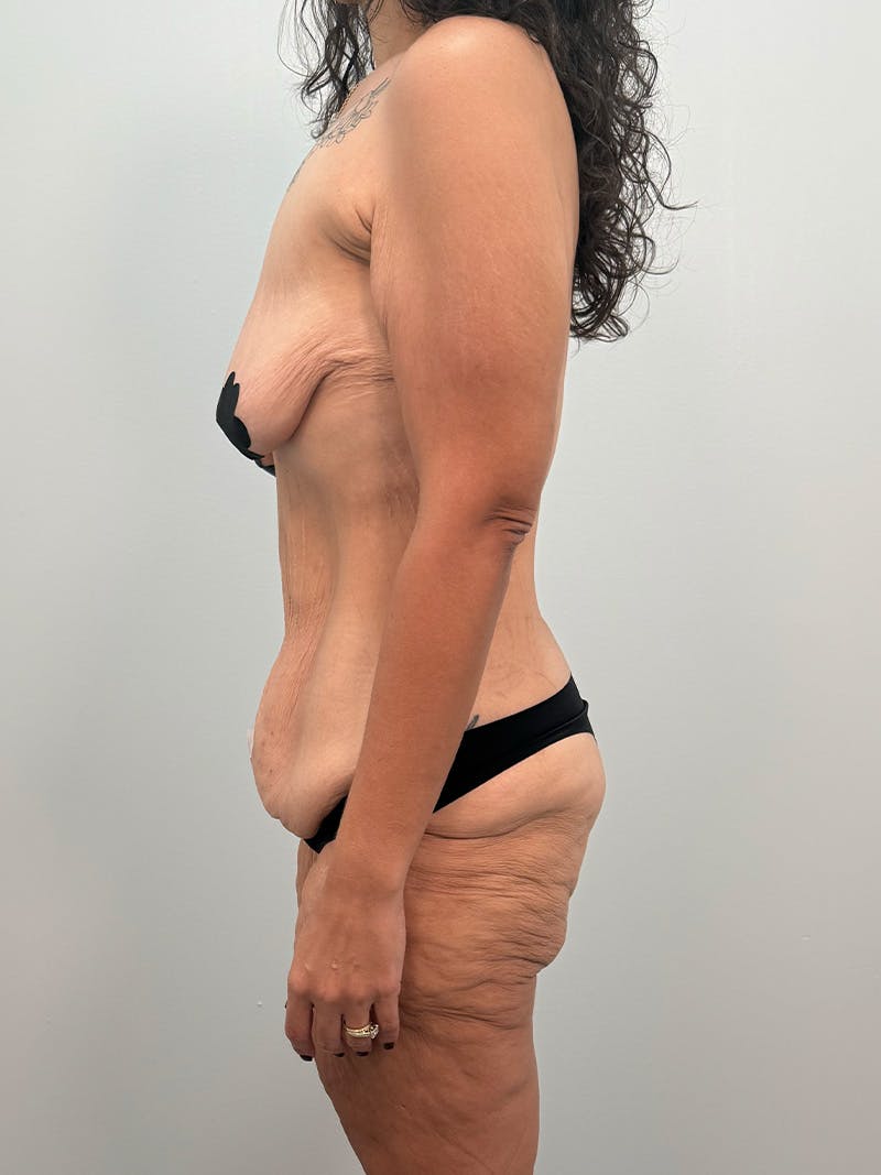 Brazilian Butt Lift Before & After Gallery - Patient 193824 - Image 11