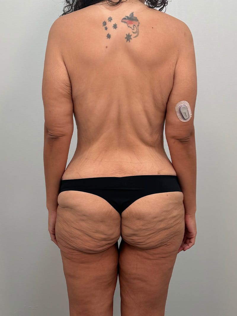 Brazilian Butt Lift Before & After Gallery - Patient 193824 - Image 1