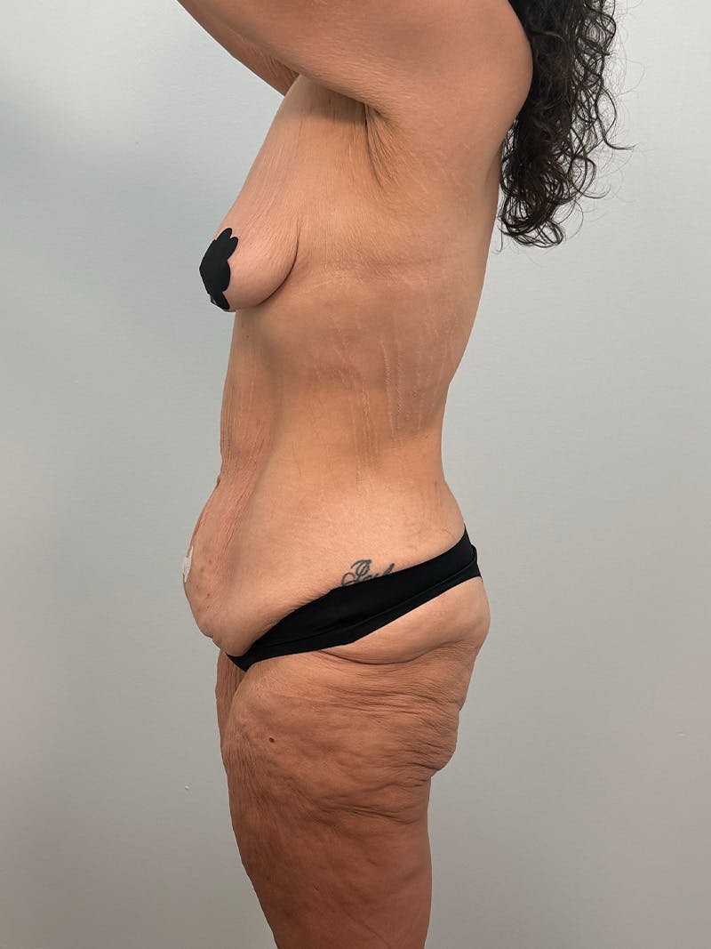 Brazilian Butt Lift Before & After Gallery - Patient 193824 - Image 13