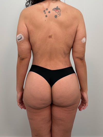 Brazilian Butt Lift Before & After Gallery - Patient 193824 - Image 2