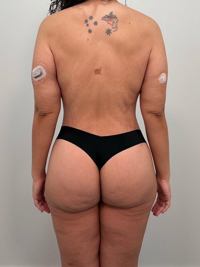 Brazilian Butt Lift Before & After Gallery - Patient 193824 - Image 2