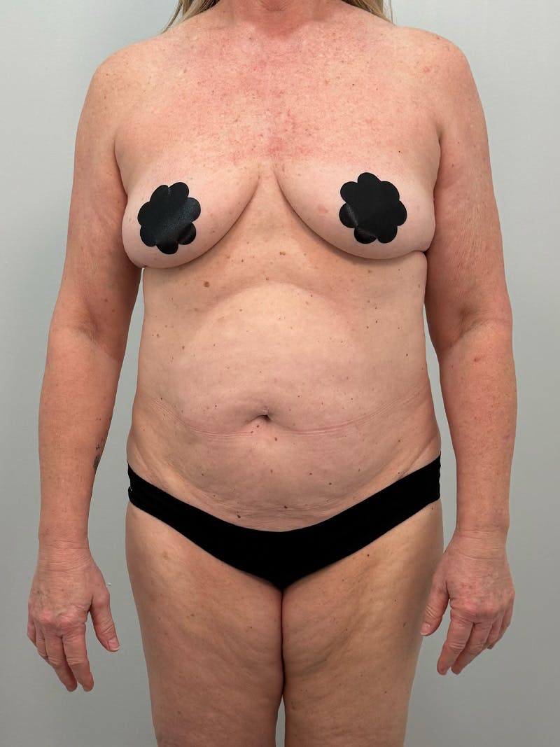 Mommy Makeover Before & After Gallery - Patient 112941 - Image 1