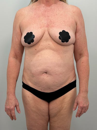 Mommy Makeover Before & After Gallery - Patient 112941 - Image 1