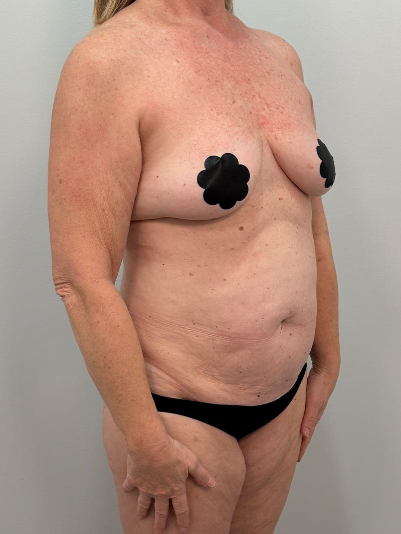 Mommy Makeover Before & After Gallery - Patient 112941 - Image 3