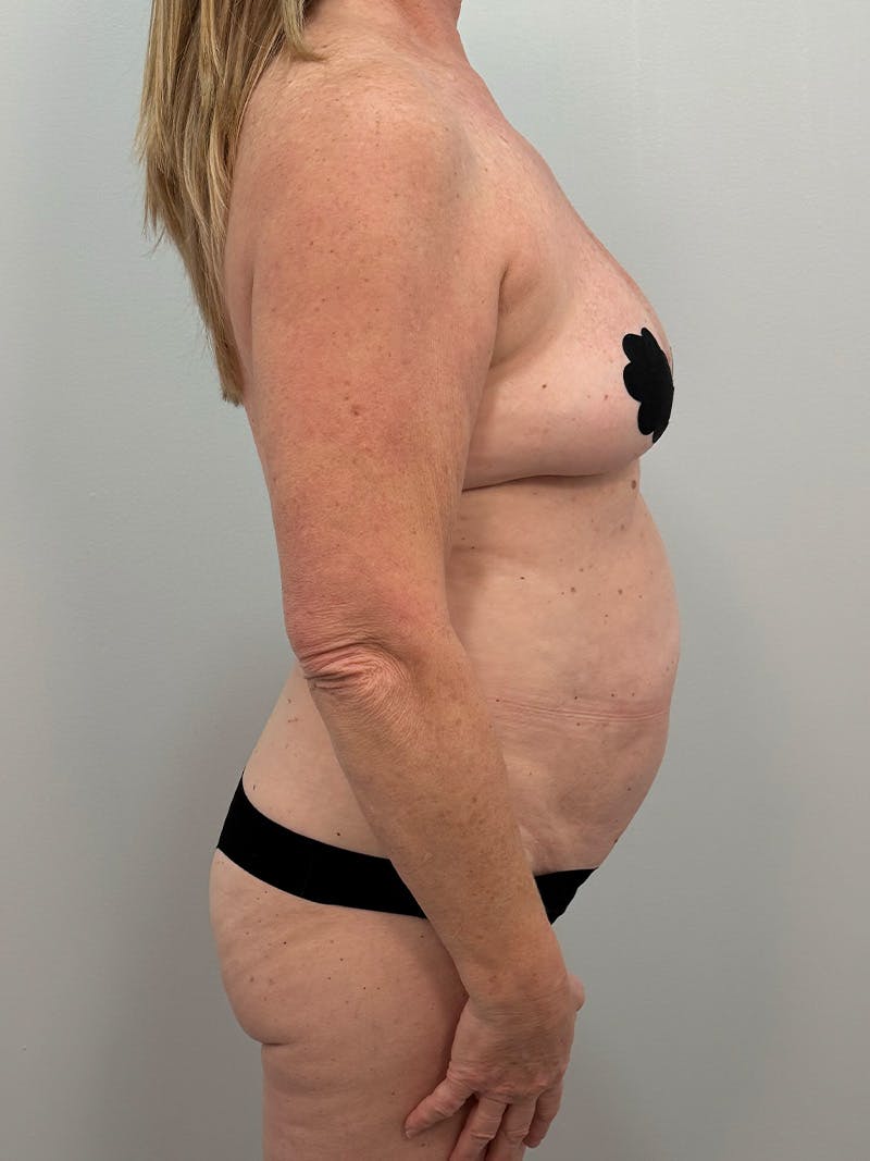 Mommy Makeover Before & After Gallery - Patient 112941 - Image 5