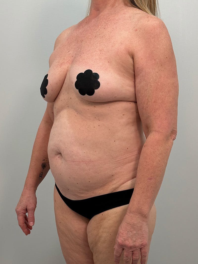 Mommy Makeover Before & After Gallery - Patient 112941 - Image 7