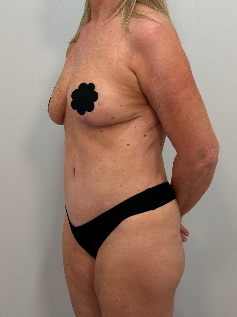 Mommy Makeover Before & After Gallery - Patient 112941 - Image 8