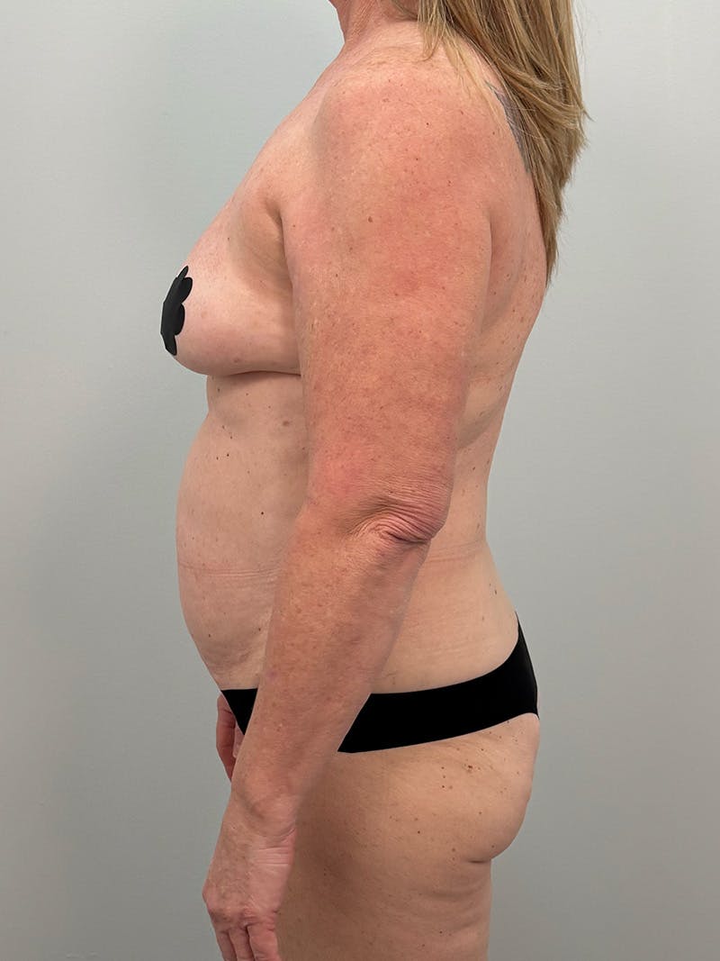Mommy Makeover Before & After Gallery - Patient 112941 - Image 9
