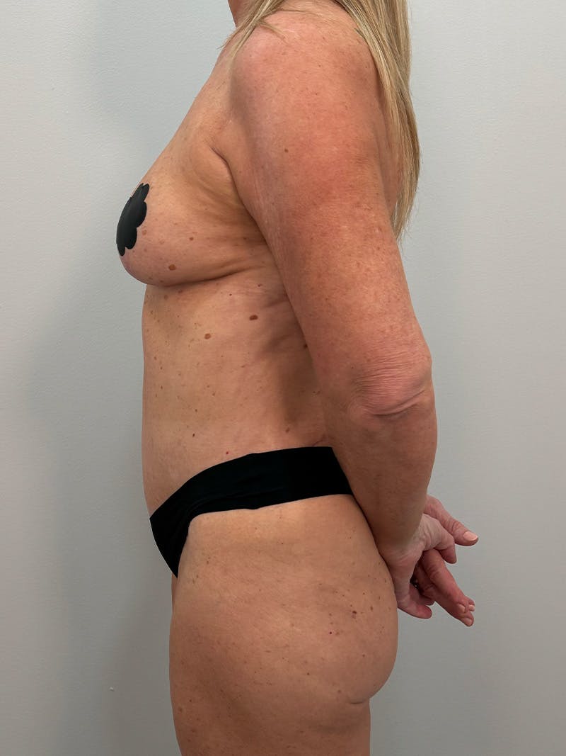 Mommy Makeover Before & After Gallery - Patient 112941 - Image 10