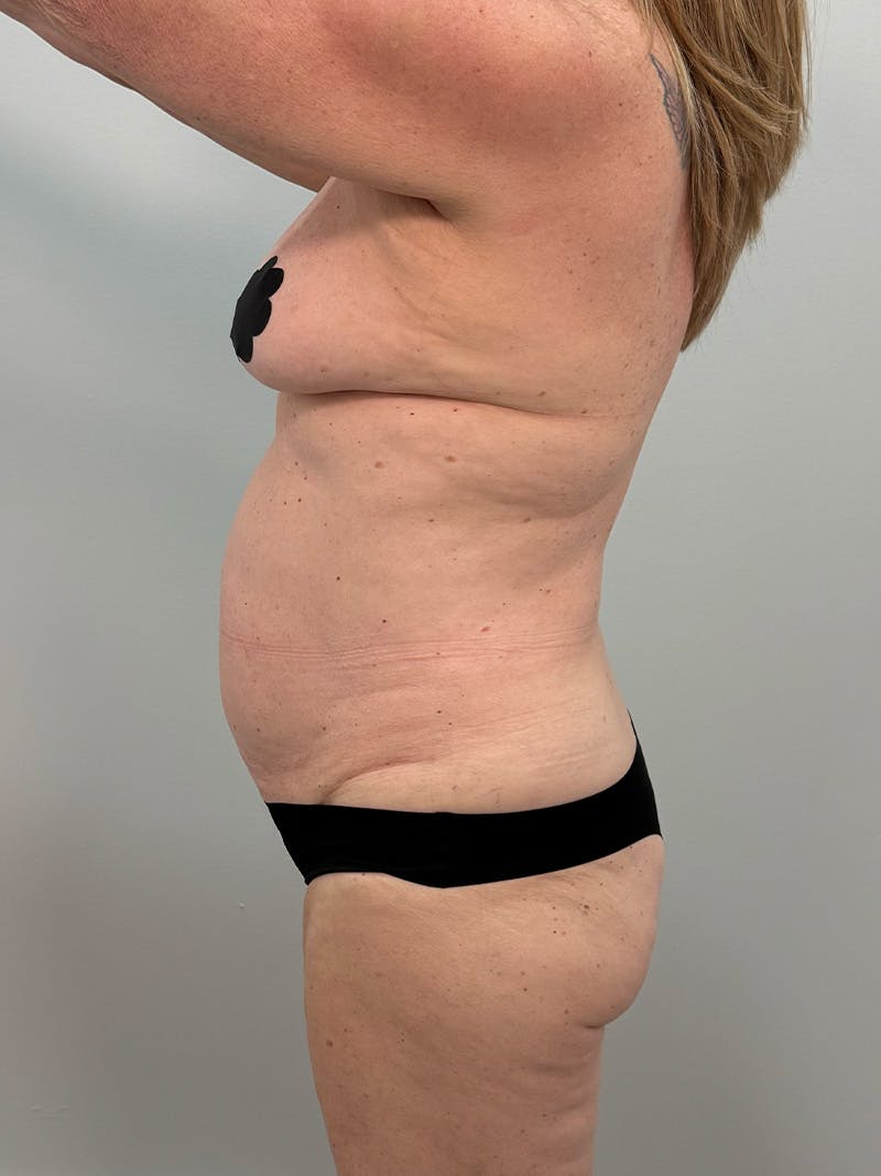 Mommy Makeover Before & After Gallery - Patient 112941 - Image 11