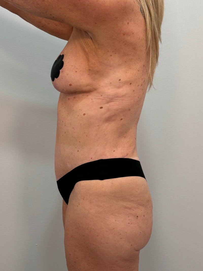 Mommy Makeover Before & After Gallery - Patient 112941 - Image 12