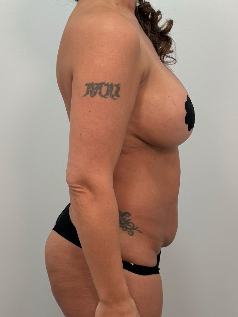 Mommy Makeover Before & After Gallery - Patient 148997 - Image 5