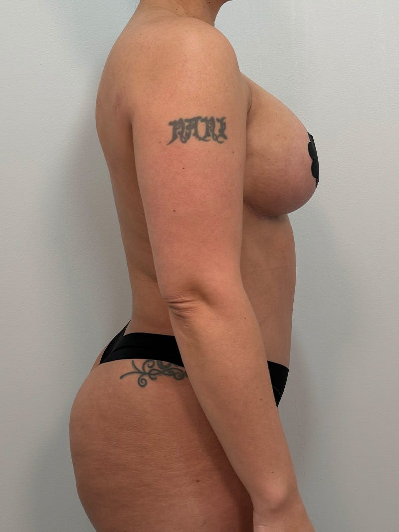 Mommy Makeover Before & After Gallery - Patient 148997 - Image 6