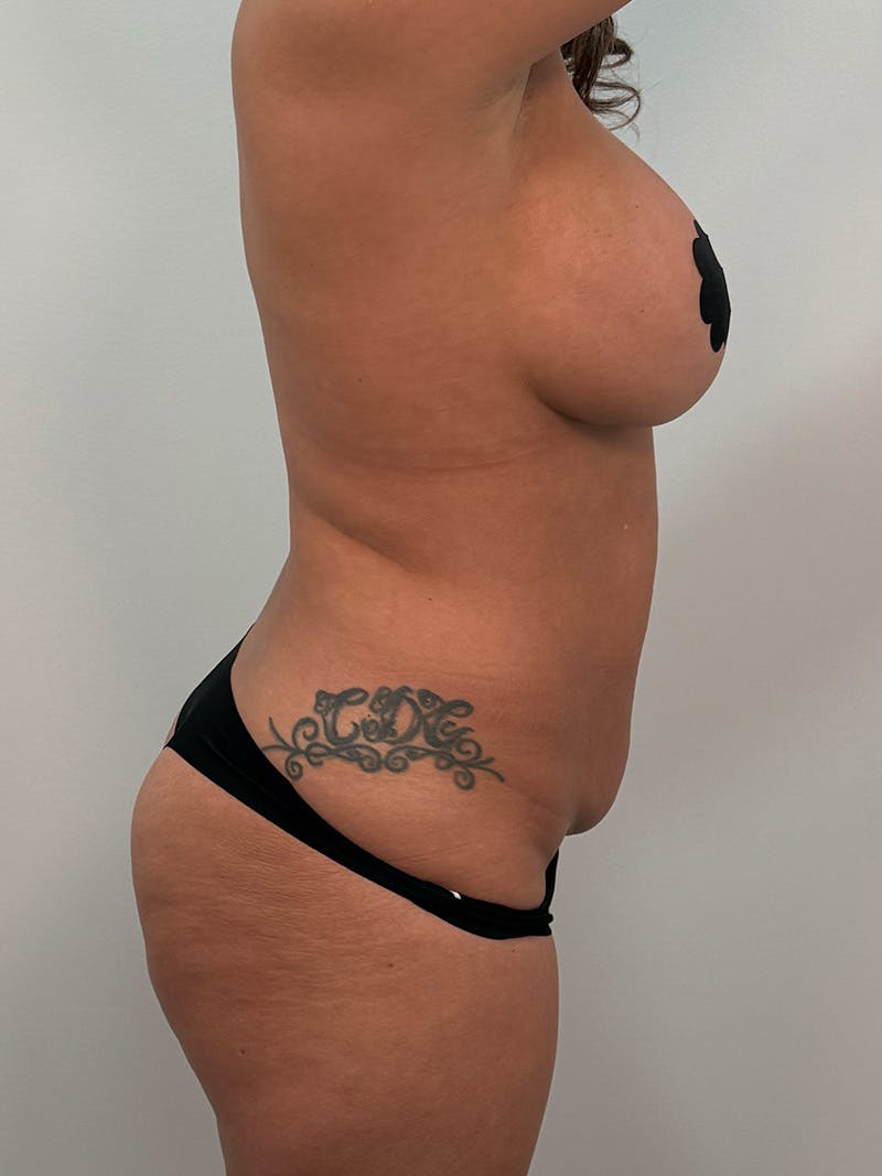 Mommy Makeover Before & After Gallery - Patient 148997 - Image 7