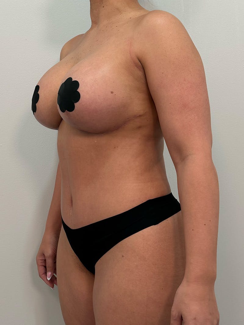 Mommy Makeover Before & After Gallery - Patient 148997 - Image 10
