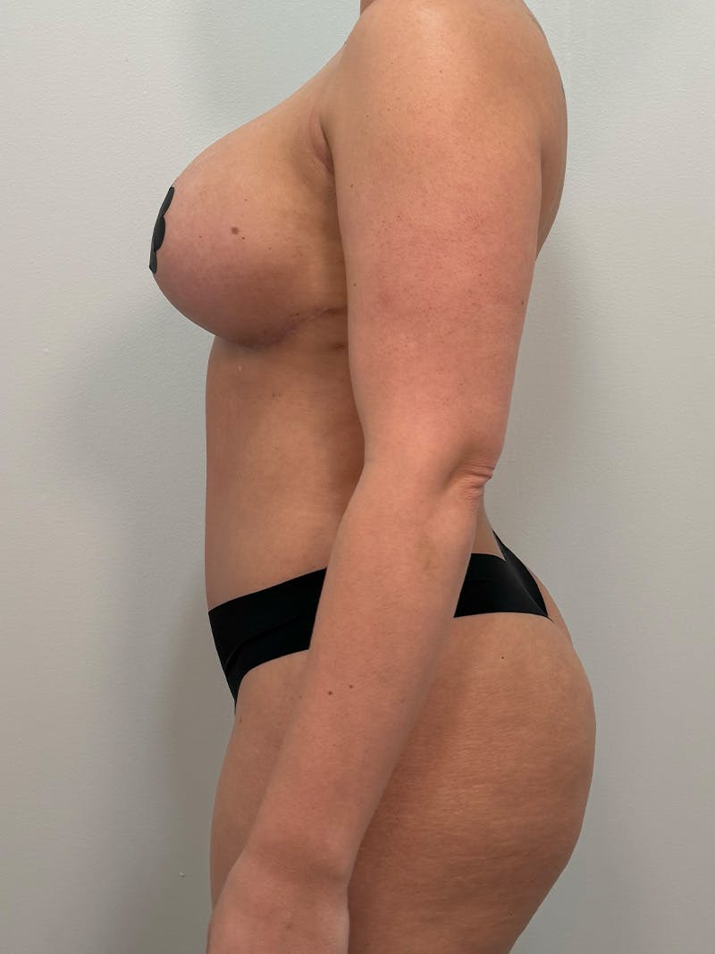 Mommy Makeover Before & After Gallery - Patient 148997 - Image 12