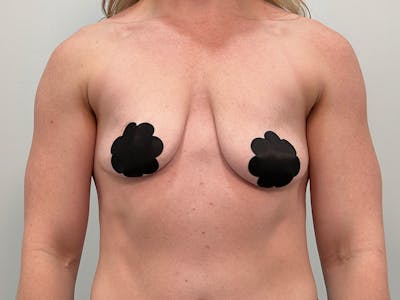 Breast Augmentation-Mastopexy Before & After Gallery - Patient 518995 - Image 1