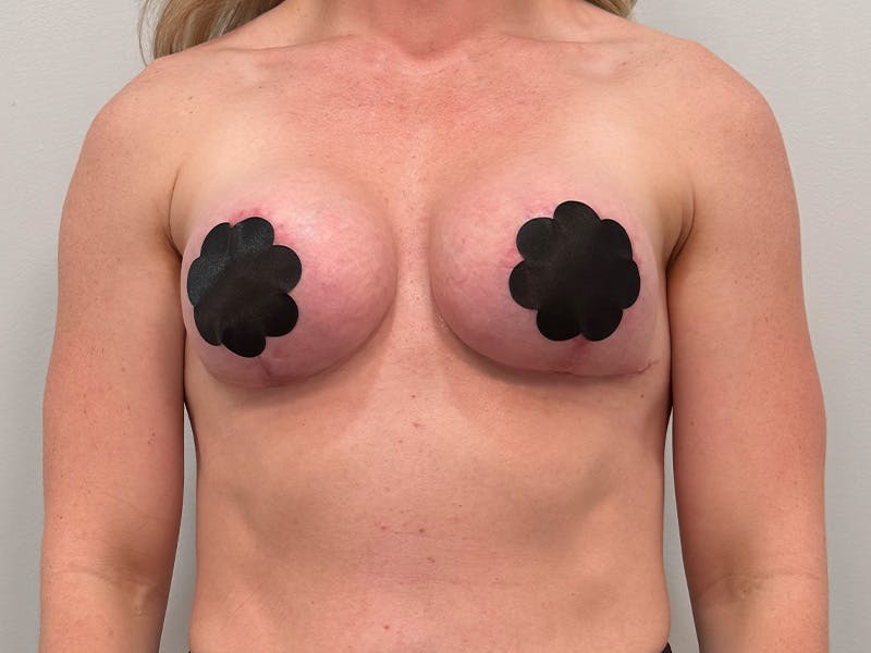Breast Augmentation-Mastopexy Before & After Gallery - Patient 518995 - Image 2