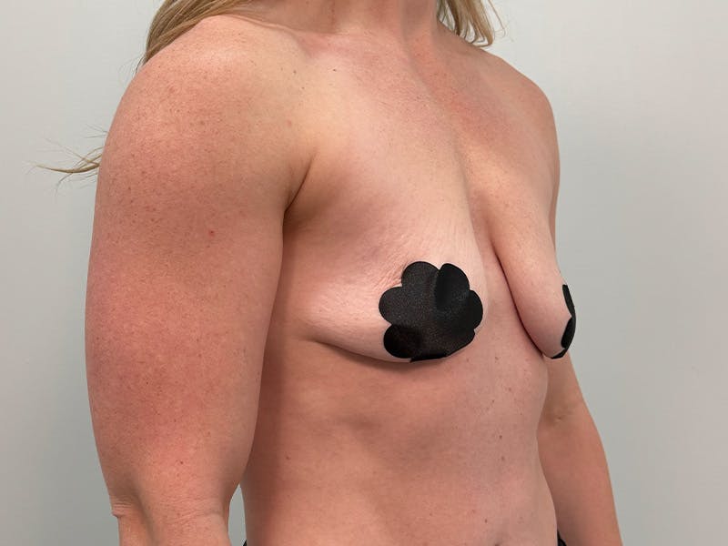 Breast Augmentation-Mastopexy Before & After Gallery - Patient 518995 - Image 3