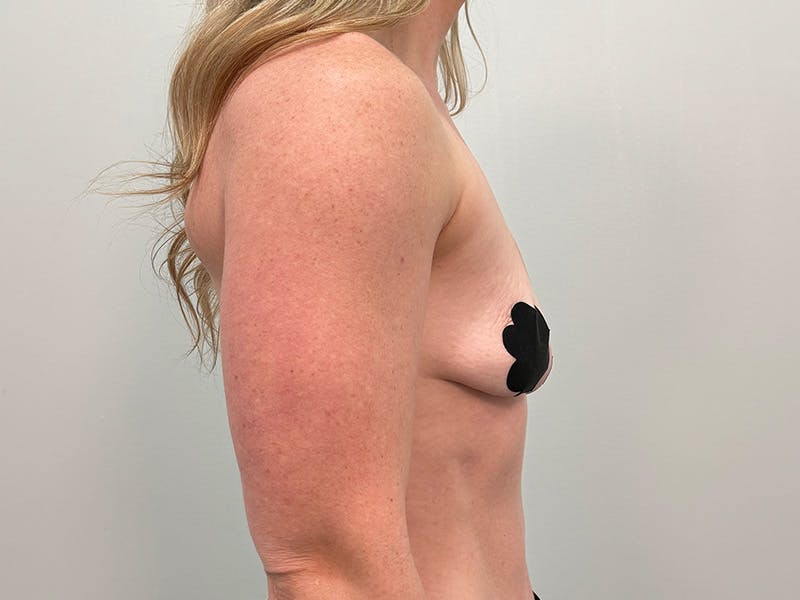 Breast Augmentation-Mastopexy Before & After Gallery - Patient 518995 - Image 5