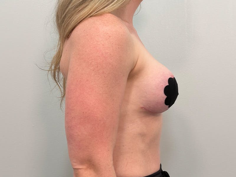 Breast Augmentation-Mastopexy Before & After Gallery - Patient 518995 - Image 6