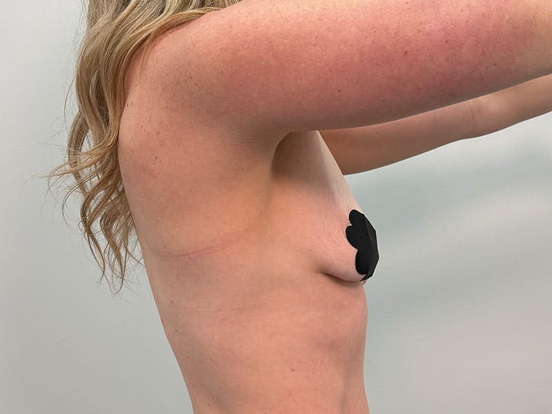 Breast Augmentation-Mastopexy Before & After Gallery - Patient 518995 - Image 7