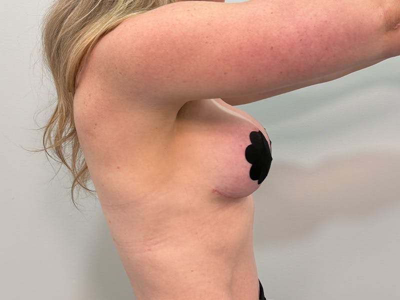 Breast Augmentation-Mastopexy Before & After Gallery - Patient 518995 - Image 8