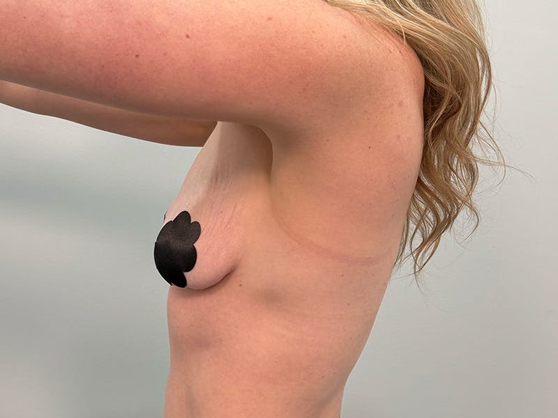 Breast Augmentation-Mastopexy Before & After Gallery - Patient 518995 - Image 13
