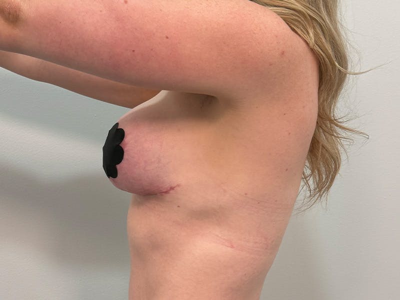 Breast Augmentation-Mastopexy Before & After Gallery - Patient 518995 - Image 14