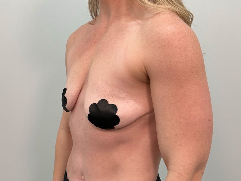 Breast Augmentation-Mastopexy Before & After Gallery - Patient 518995 - Image 9