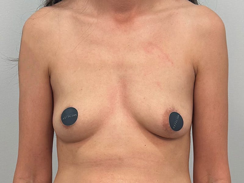 Breast Augmentation Before & After Gallery - Patient 311024 - Image 1