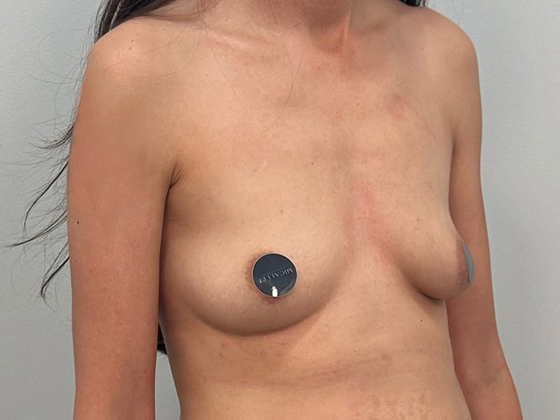Breast Augmentation Before & After Gallery - Patient 311024 - Image 3
