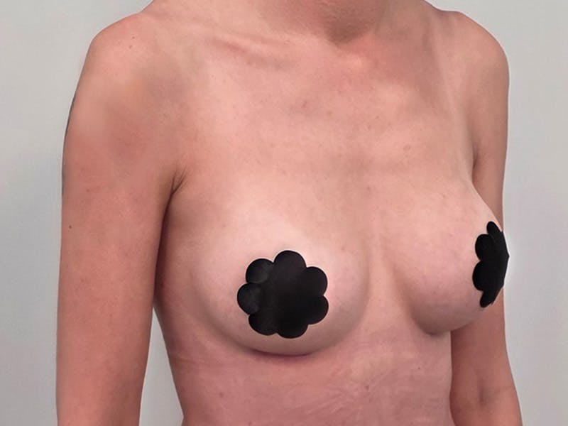 Breast Augmentation Before & After Gallery - Patient 311024 - Image 4