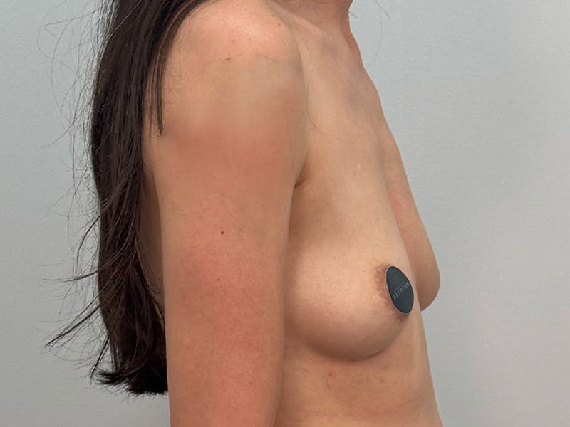 Breast Augmentation Before & After Gallery - Patient 311024 - Image 5