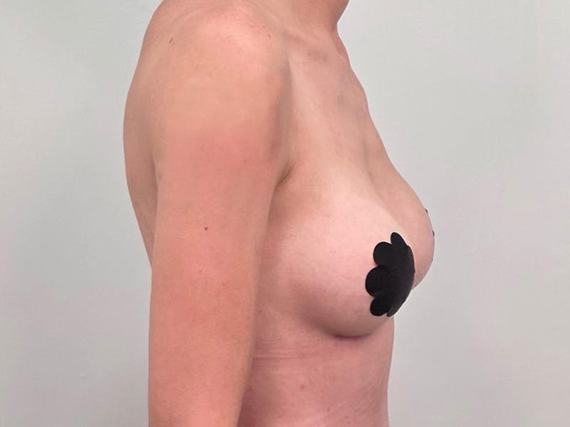 Breast Augmentation Before & After Gallery - Patient 311024 - Image 6