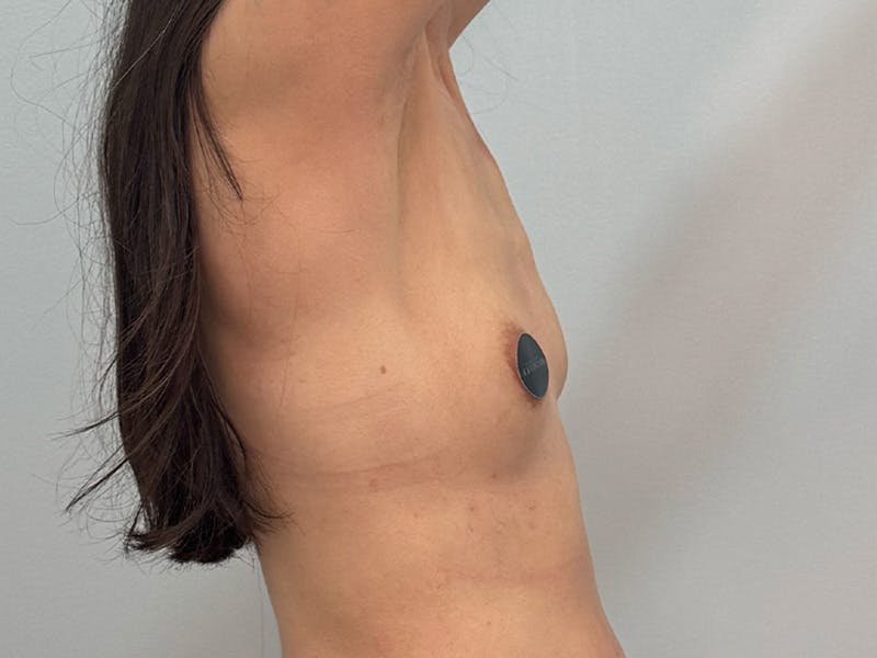 Breast Augmentation Before & After Gallery - Patient 311024 - Image 7