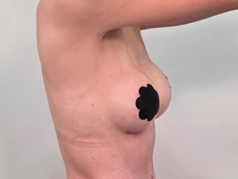 Breast Augmentation Before & After Gallery - Patient 311024 - Image 8