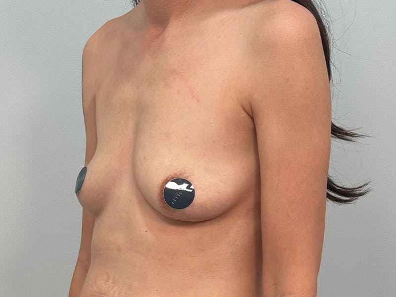 Breast Augmentation Before & After Gallery - Patient 311024 - Image 9