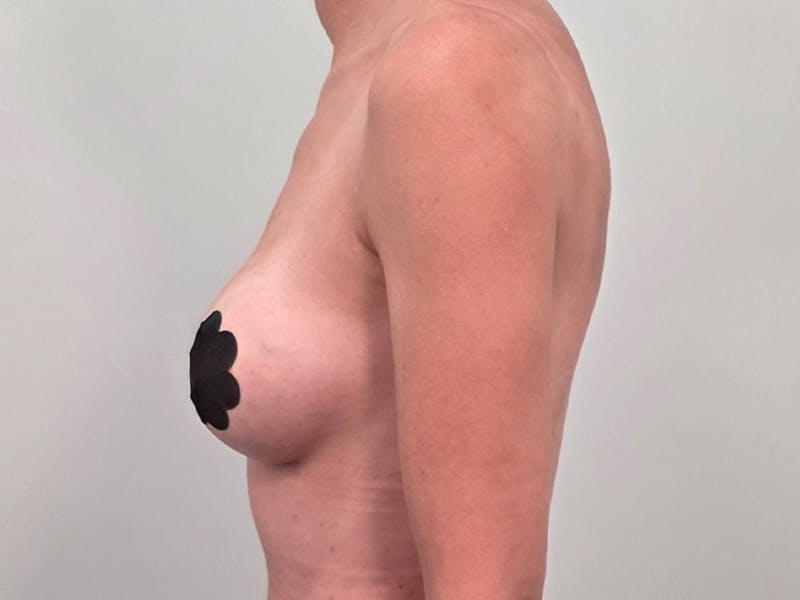 Breast Augmentation Before & After Gallery - Patient 311024 - Image 12