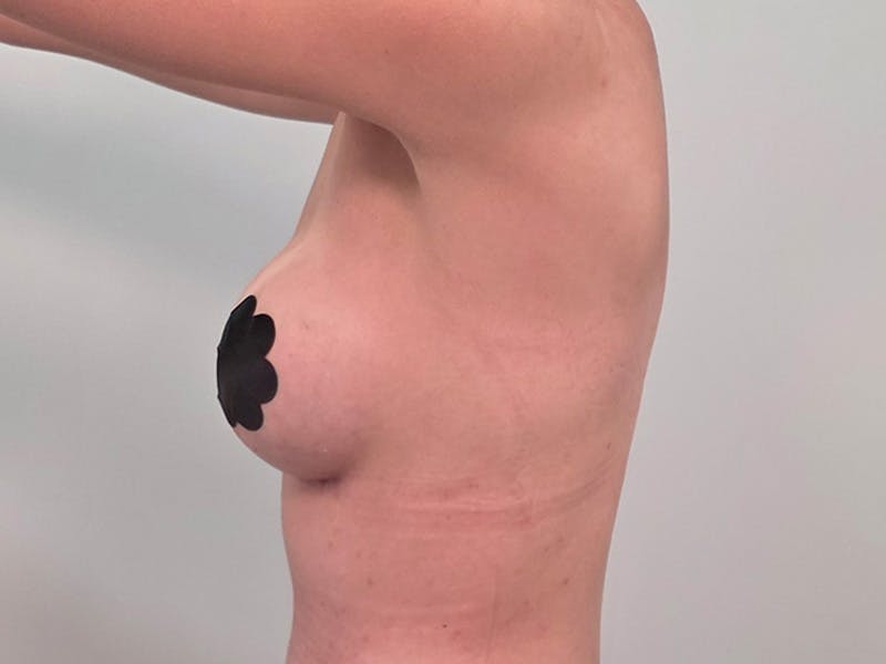 Breast Augmentation Before & After Gallery - Patient 311024 - Image 14