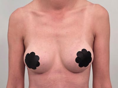 Breast Augmentation Before & After Gallery - Patient 311024 - Image 2