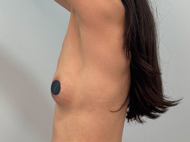 Breast Augmentation Before & After Gallery - Patient 311024 - Image 13