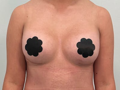 Breast Augmentation Before & After Gallery - Patient 107234 - Image 2