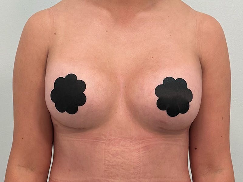 Breast Augmentation Before & After Gallery - Patient 107234 - Image 2