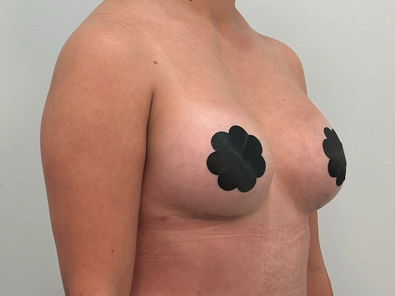 Breast Augmentation Before & After Gallery - Patient 107234 - Image 4